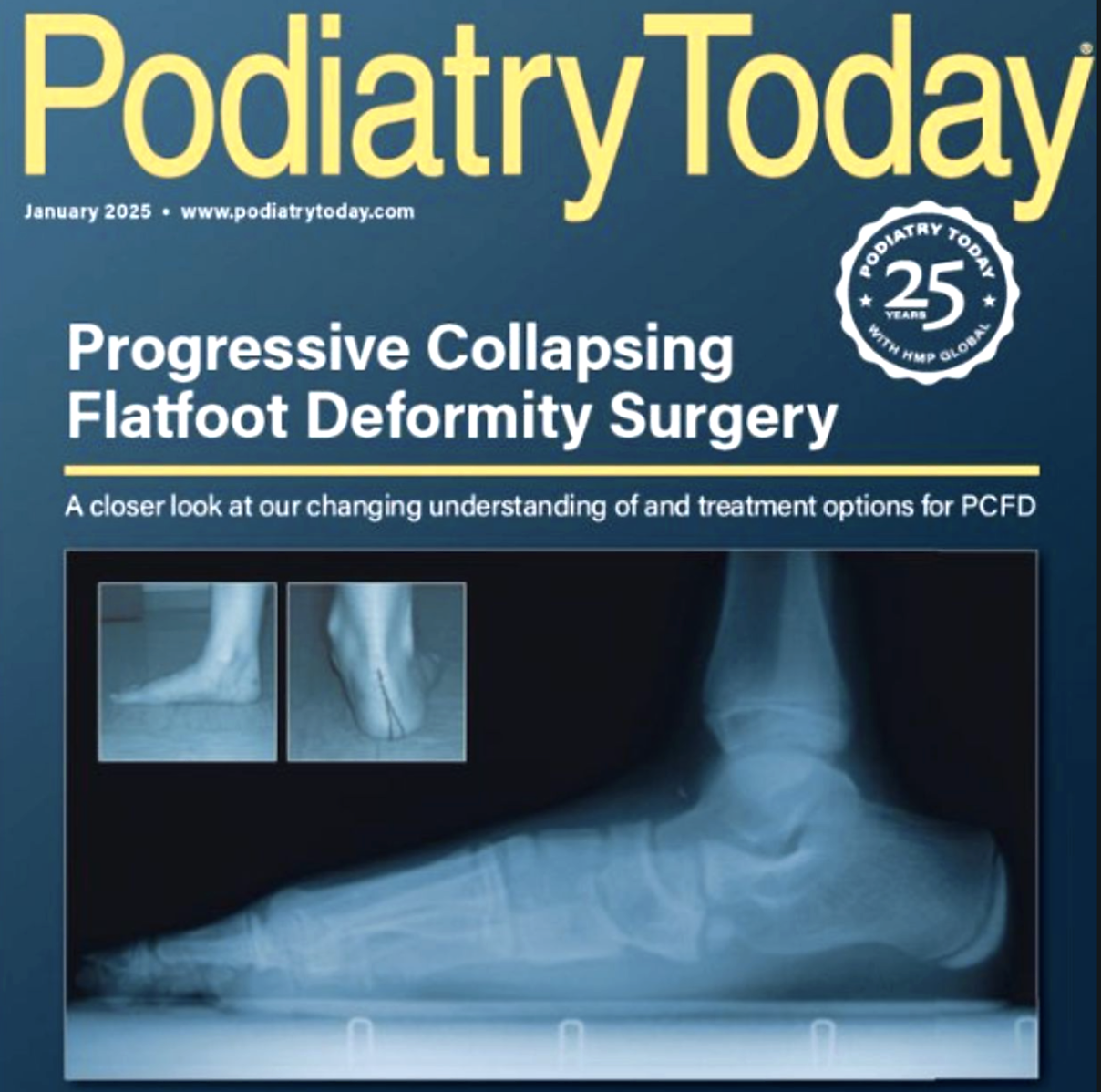 Podiatry Today cover feature on progressive collapsing flatfoot deformity surgery